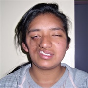 Parry–Romberg Syndrome