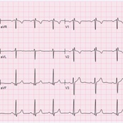 Sinus Arrhythmia