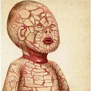 Harlequin-Type Ichthyosis