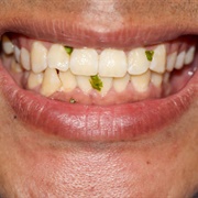 Have Food Stuck Inbetween Your Teeth