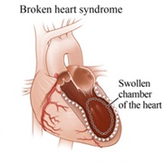 Broken Heart Syndrome