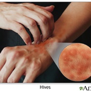 Had Hives