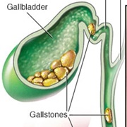 Gallstones