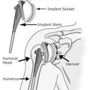 Redo Shoulder Replacement