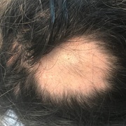 Hair Falling Out in Clumps