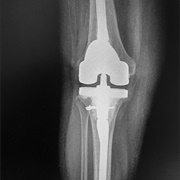 Full Knee Replacement