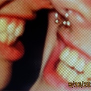Teethcore