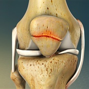 Cracked Kneecap