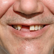 Front Teeth Knocked Out