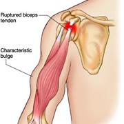Right Bicep Surgery