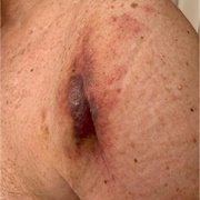 Shoulder Replacement Gets Infected