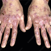 Epidermolysis Bullosa