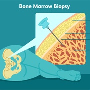 Bone Marrow Biopsy