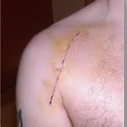 2 Left Shoulder Surgeries