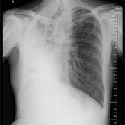 Had a Collapsed Lung