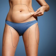 Liposuction