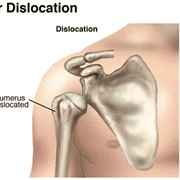 Dislocate Left Shoulder 2