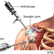 Artho Surgery on Right Shoulder