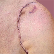 Surgery on Left Shoulder