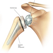 Full Shoulder Replacement
