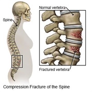 Fractured Vertebrae