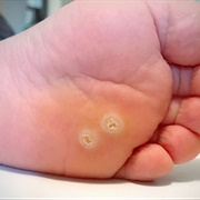 Plantars Wart