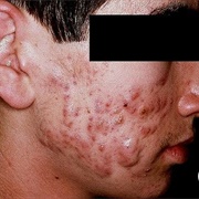 Severe Acne