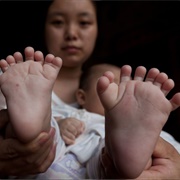 Being Born With Extra Fingers or Toes: 1 in Every 500 to 1,000 Births