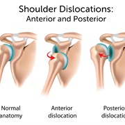 Dislocated Left Shoulder