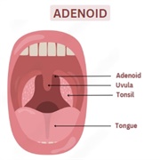 Adenoids Sign