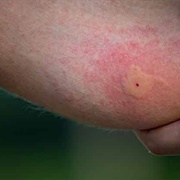 Mosquito Bites