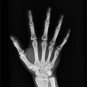 Hand X-Ray