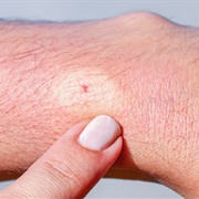 Getting Stung by a Bee