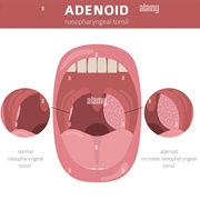 Adenoid