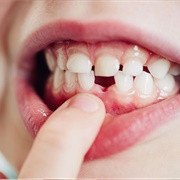 Stick Your Tongue in the Little Spaces Where Your Teeth Were That Fell Out