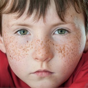 Freckles