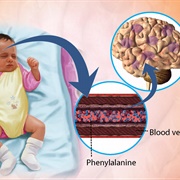 Phenylketonuria (PKD)