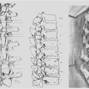 Dr. Russell A. Hibbs  First Spinal Fusion 1911
