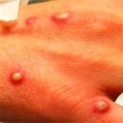Monkeypox Outbreak in United Kingdom
