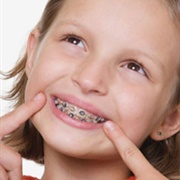 Worn Orthodontic Braces