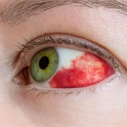 Bleeding From Eye