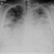 Largest Recorded Outbreak of Legionnaires' Disease