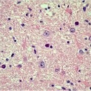 Progressive Fungal Infection