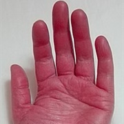 Erythromelalgia