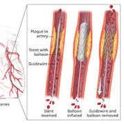 Vascular STENT