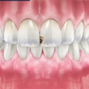 Dental Implants Surgery