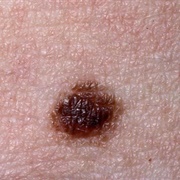 Nevus