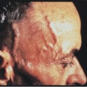Temporal Arteritis