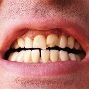 Cracked Tooth Syndrome