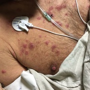 Myelodysplastic Syndrome